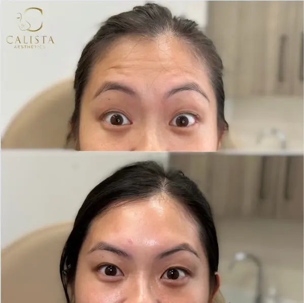Before and after images of a woman showing the results of a forehead tox treatment. The "before" image reveals visible wrinkles and fine lines on the forehead when raising her eyebrows, while the "after" image displays a smoother and more relaxed forehead with significantly reduced lines.
