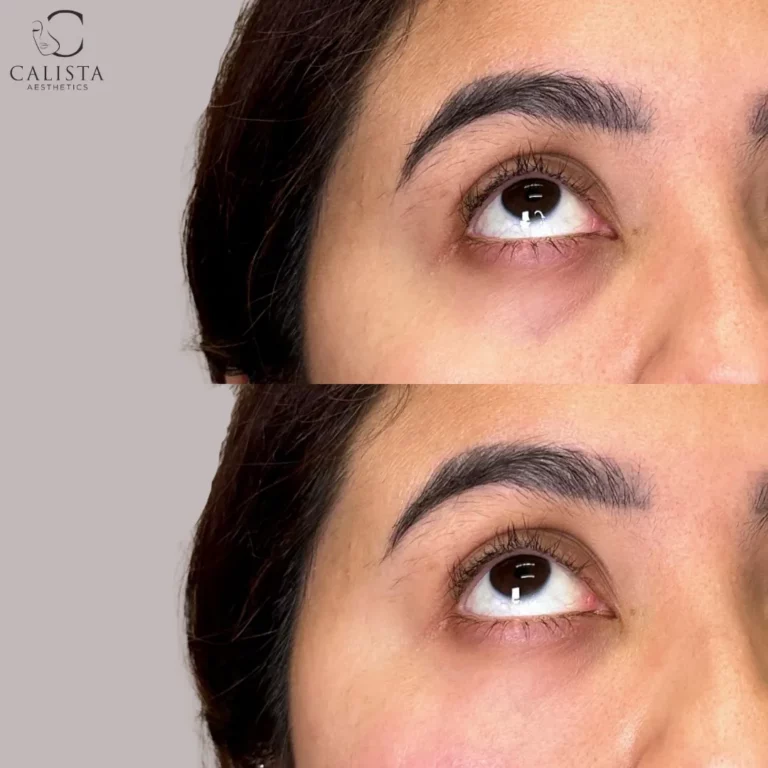 Before-and-after image of a woman’s eyes looking upwards, highlighting improvements in the under-eye area with reduced dark circles. Under eye treatment, prf ez gel.
