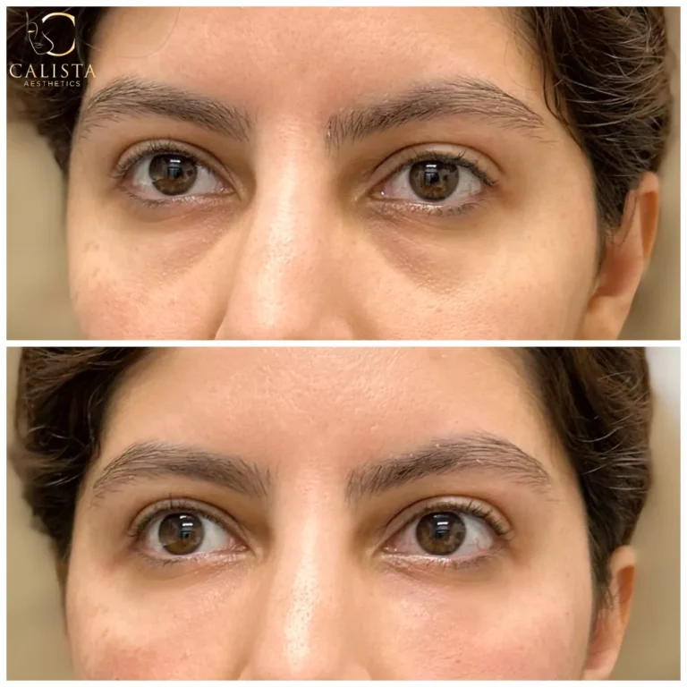 Before-and-after close-up image of a woman’s eyes showing visible improvements in under-eye texture and brightness. Under eye treatment, prf ez gel.