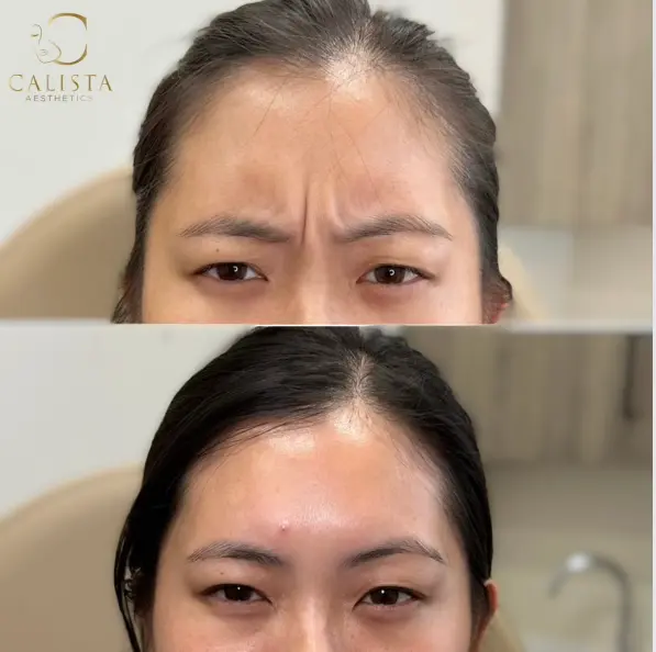 Before and after images of a woman showing the results of a forehead treatment. The before image displays visible frown lines and wrinkles between the eyebrows, while the after image shows a smooth forehead with relaxed facial muscles.