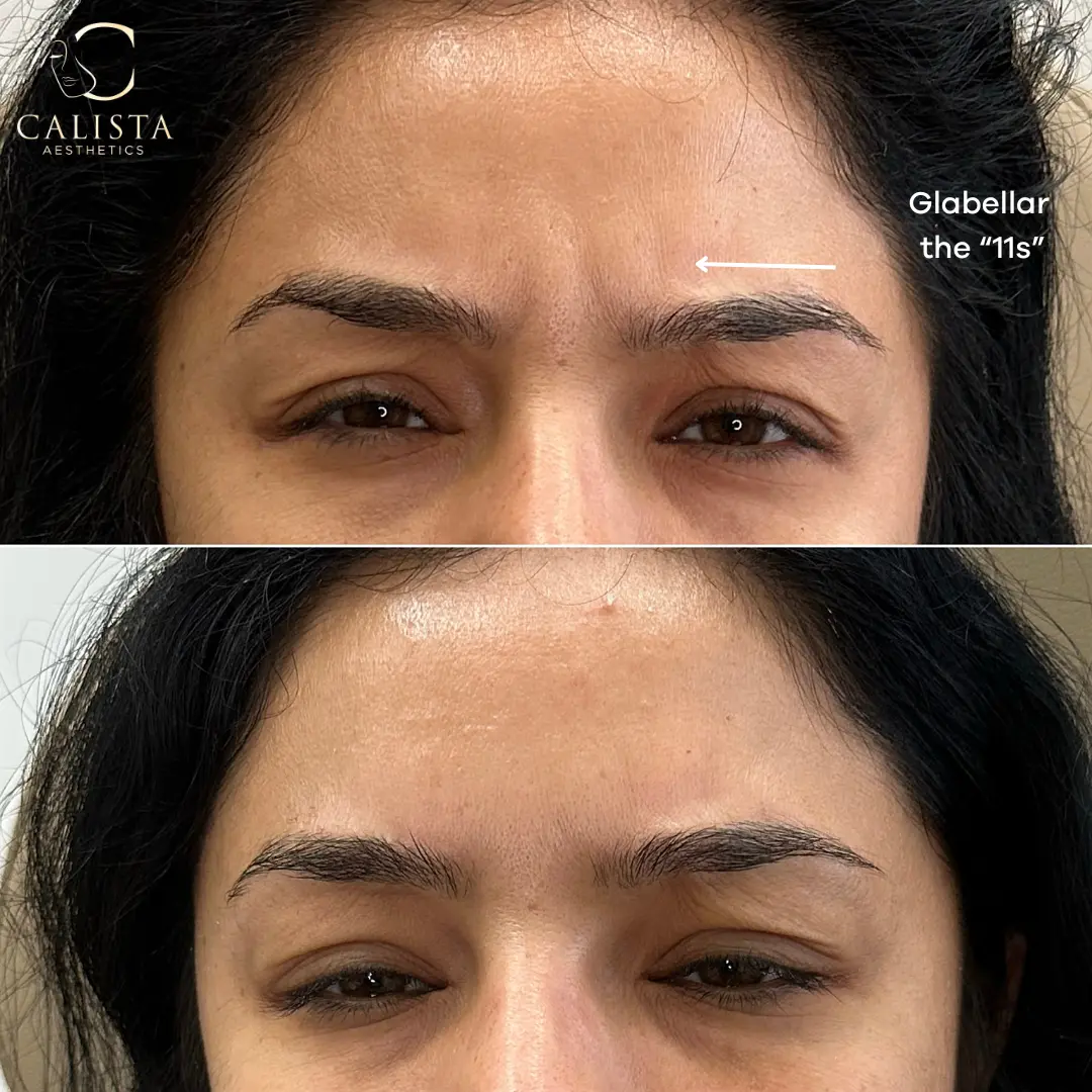 Before and after images showing the results of a treatment targeting glabellar lines between the eyebrows.