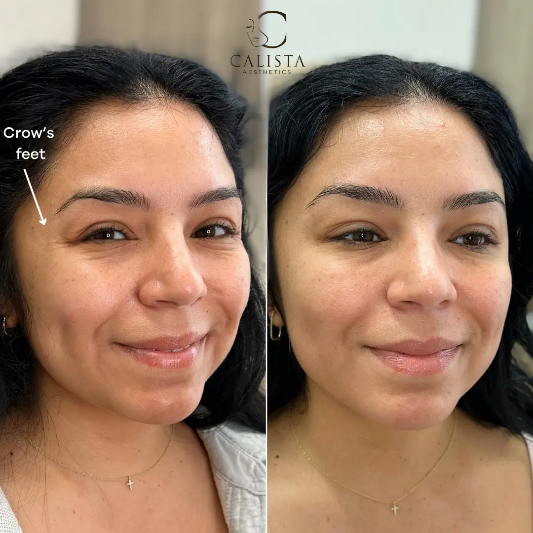 Before and after images showing the results of treatment targeting fine lines around the eyes.