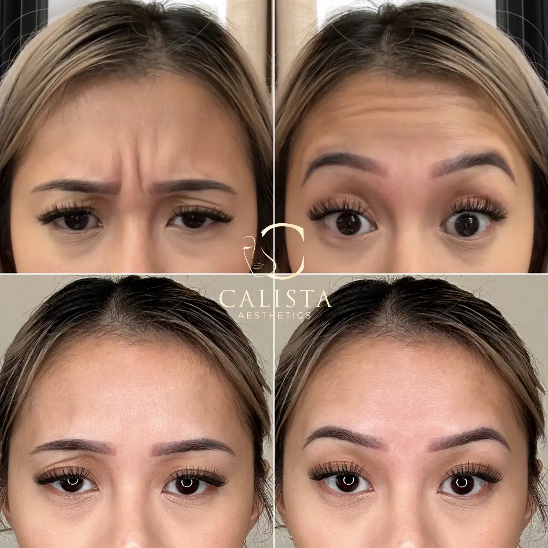 Before and after images showing the results of treatment targeting forehead wrinkles and glabellar lines.