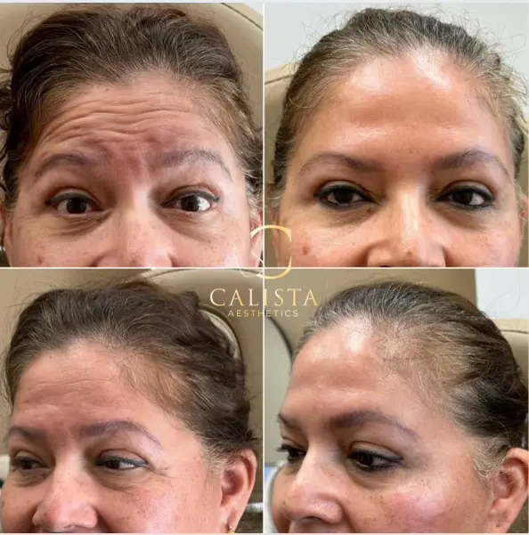 Before and after images showing results from multiple angles after treatment for forehead lines and wrinkles.