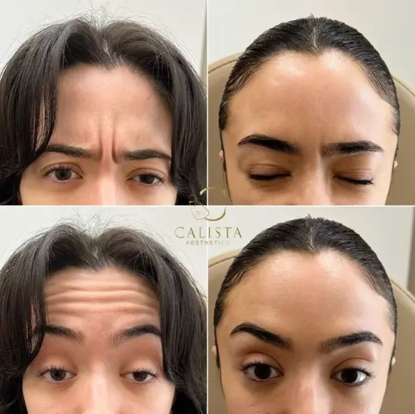 Before and after images showing the results of treatment targeting frown lines and forehead wrinkles.