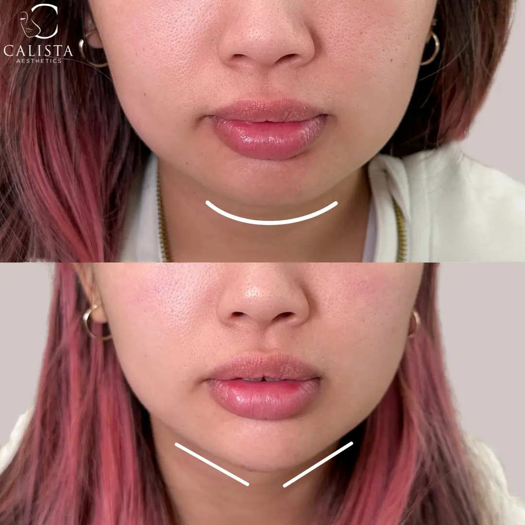 Before and after images showing the results of a chin contouring procedure.