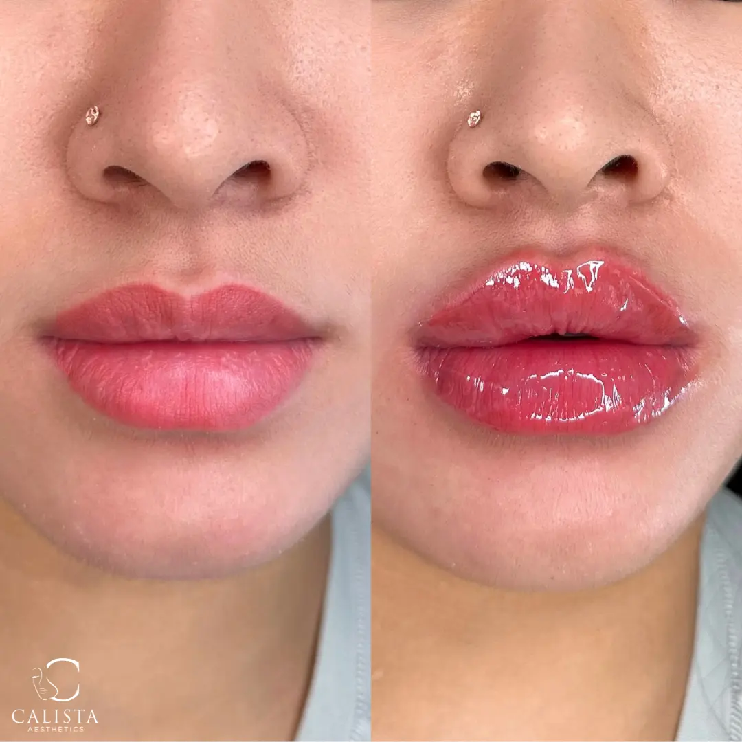 Before and after images showing the results of a lip filler treatment.