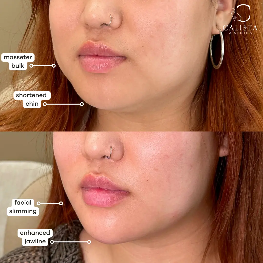 Before and after images showing the results of lower-face contouring.