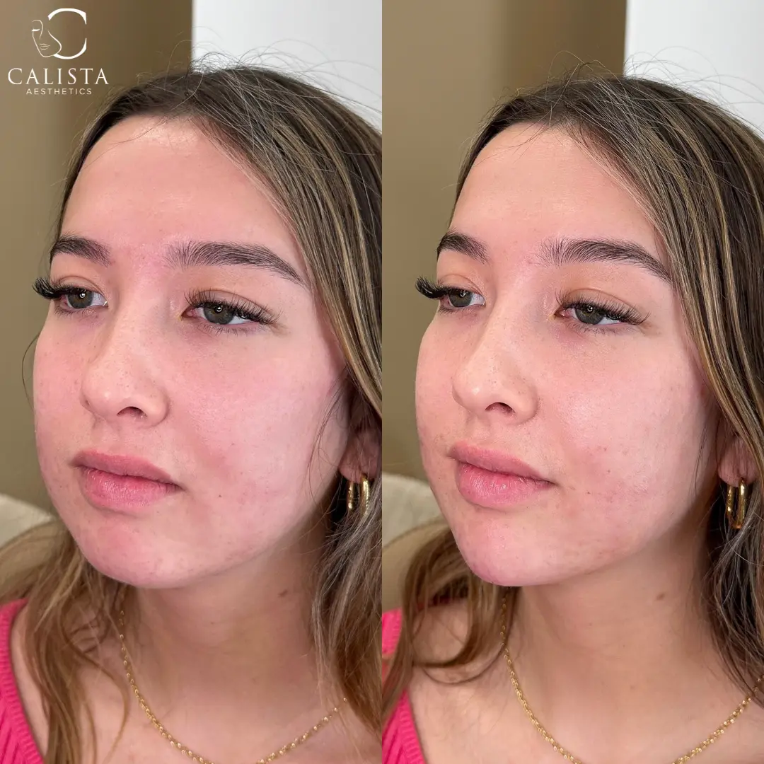 Before and after images showing the results of a chin filler treatment.