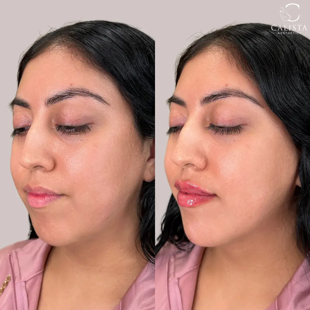 Before and after images showing the results of lower-face balancing with lip and chin filler.