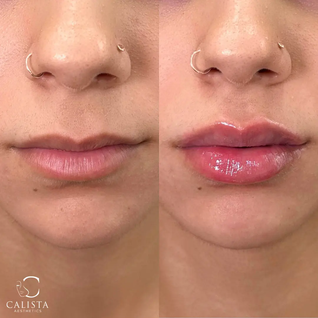 Before and after images showing the results of a lip filler procedure.