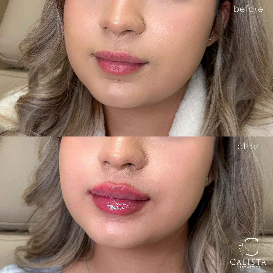 Before and after images showing the results of a lip enhancement procedure.
