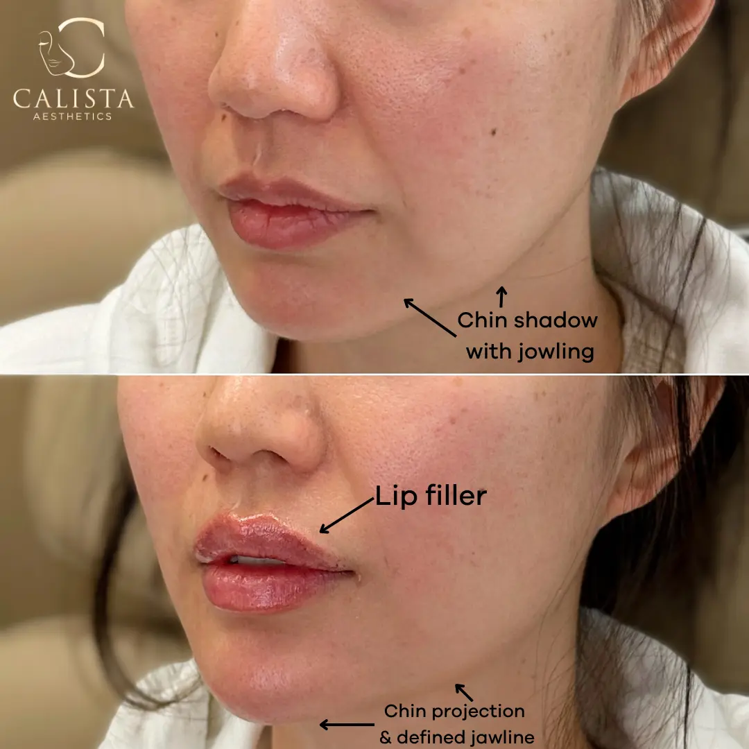 Before and after comparison showing chin projection, jawline definition, and lip filler.