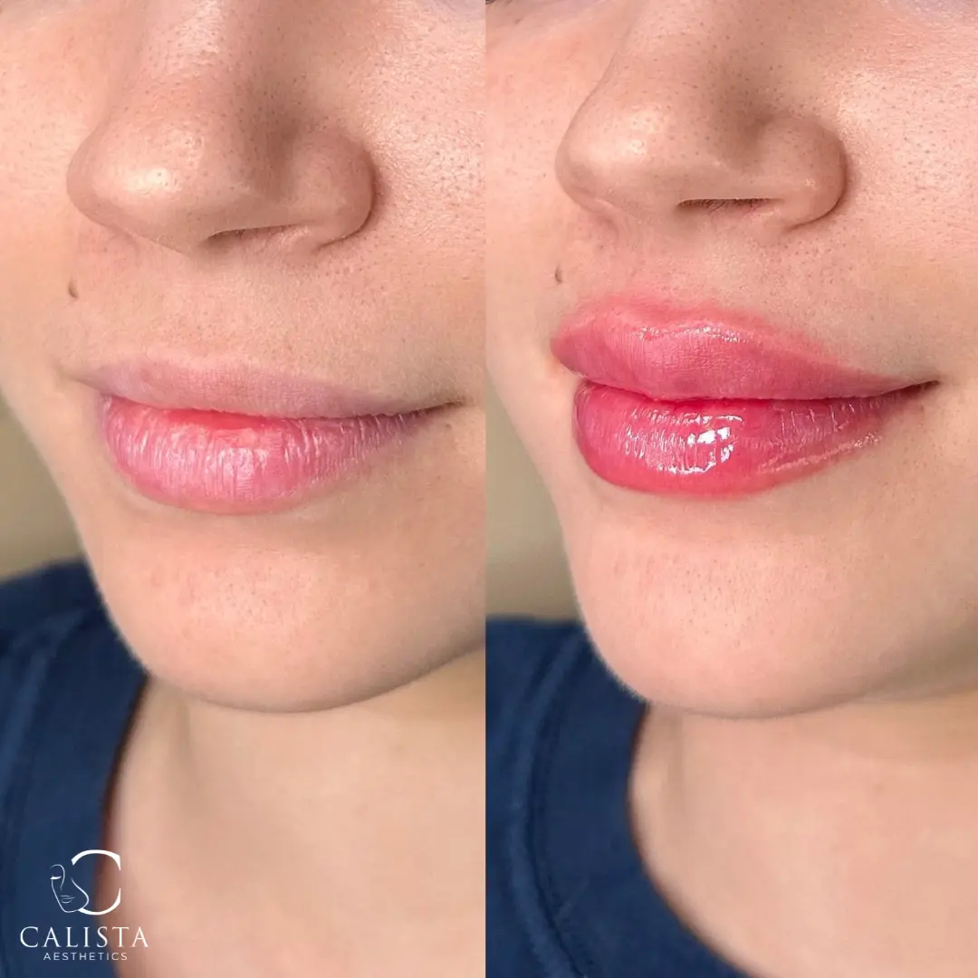 Before and after images showing the results of a lip filler treatment.