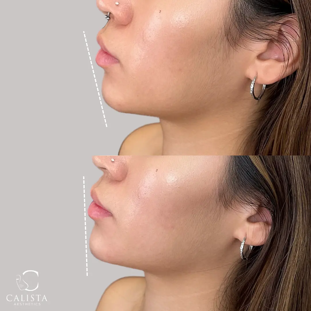 Before and after images showing the results of a chin enhancement treatment.