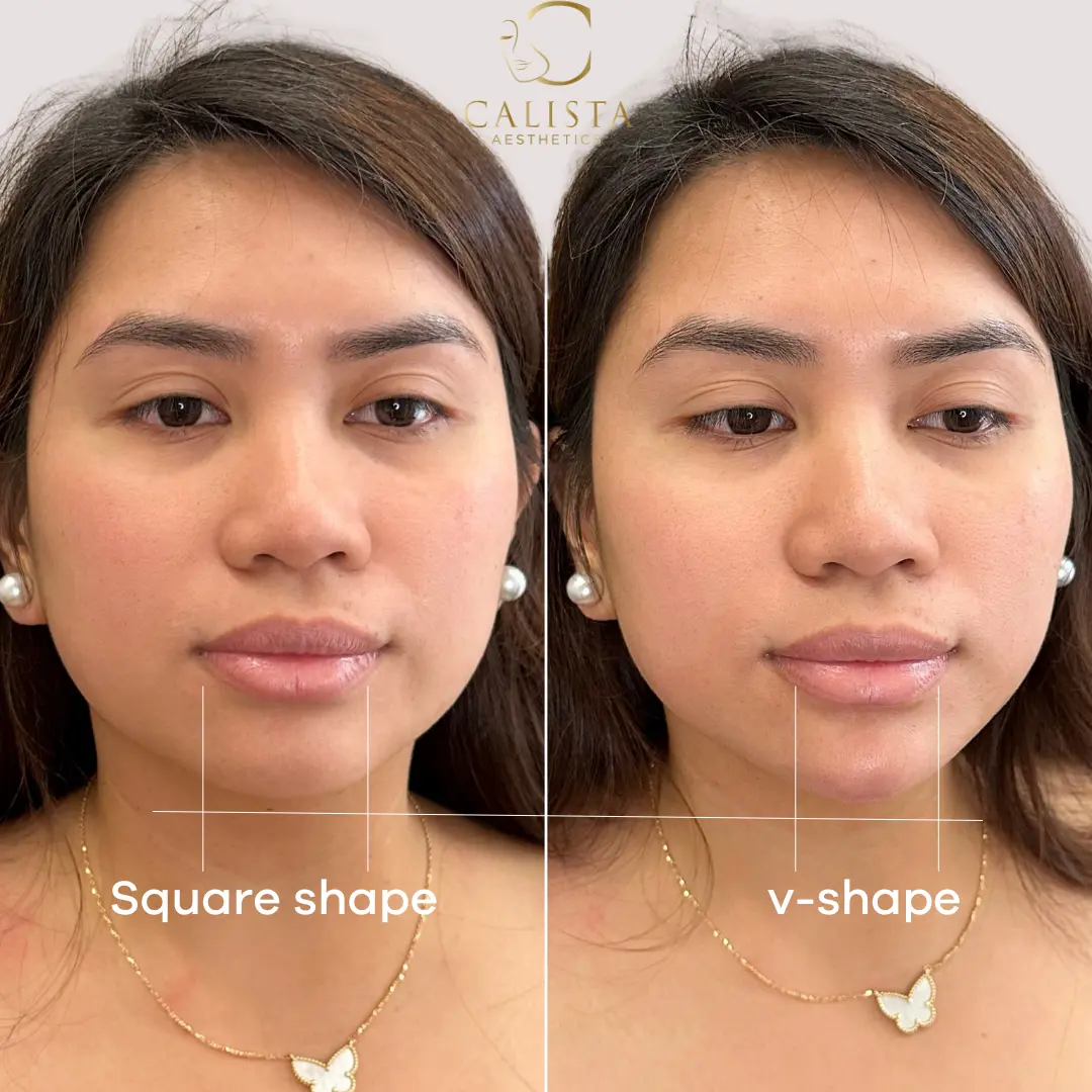 Before and after images showing the results of facial contouring with chin filler.