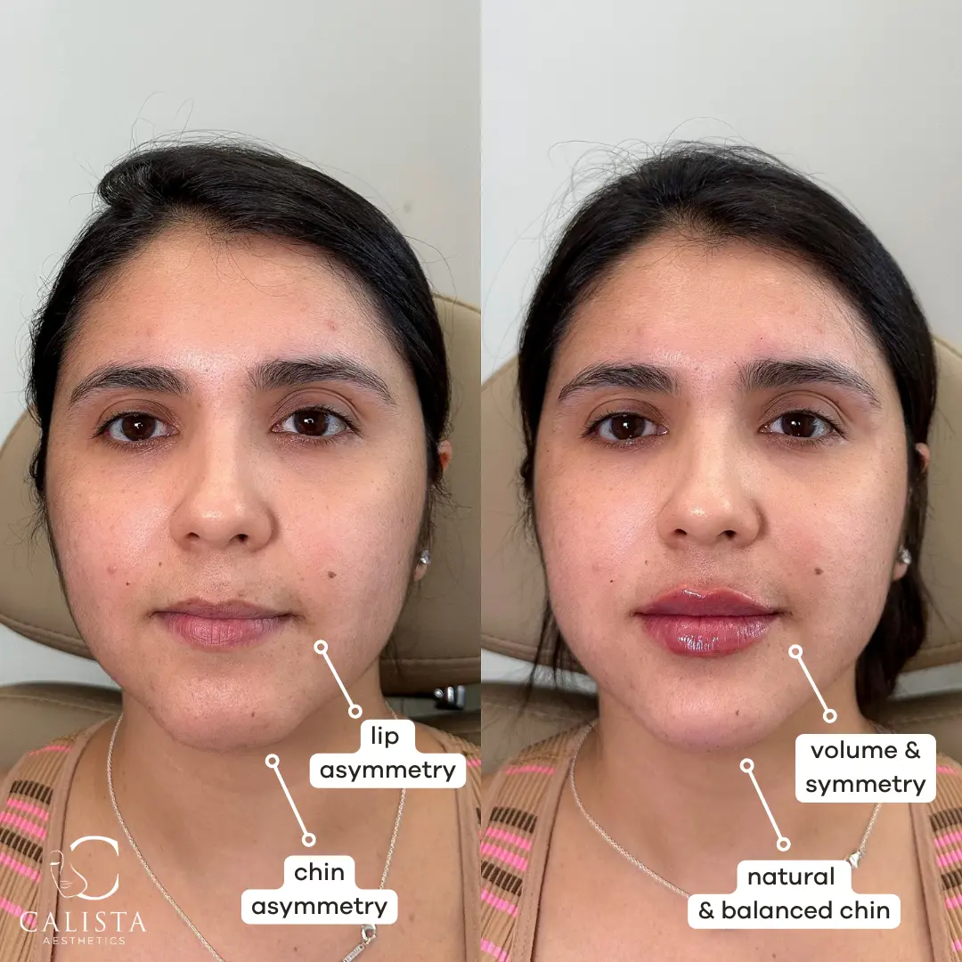 Before and after images showing the results of lip and chin enhancement.