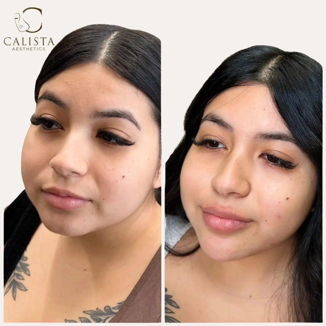 Before and after images showing the results of facial slimming treatments.
