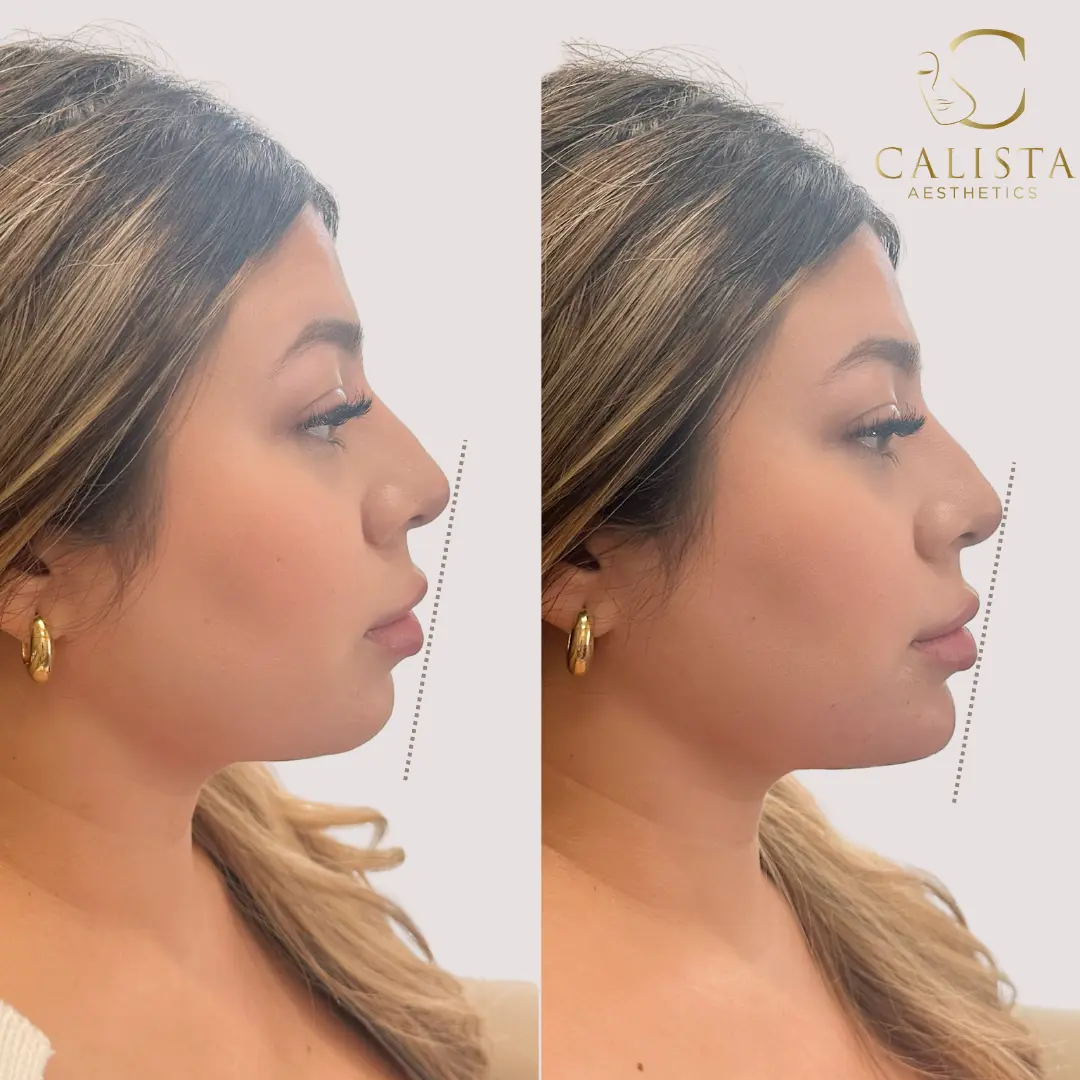 Side-by-side before and after images showing the results of chin enhancement and improved facial profile balance.