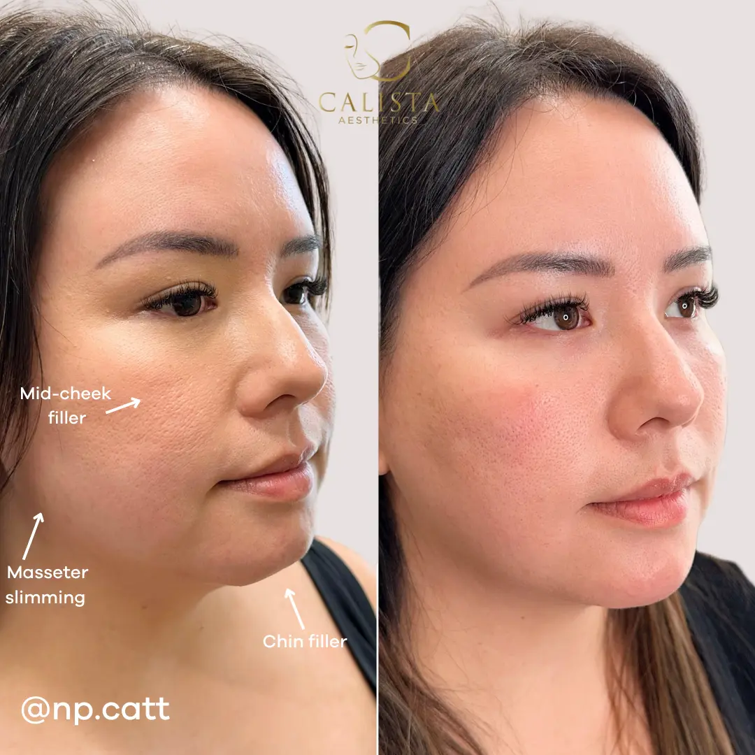 Before and after images showing the results of facial balancing treatments including cheek and chin filler.