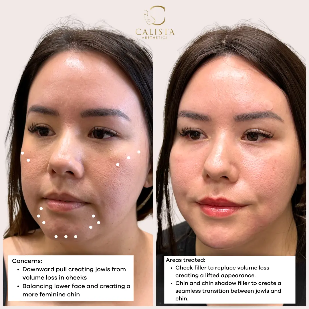 Before and after images showing facial balancing results with cheek and chin filler.