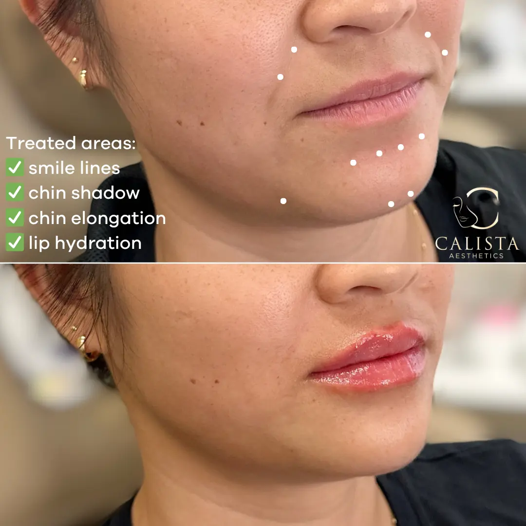 Before and after images showing the results of lower-face balancing treatments.