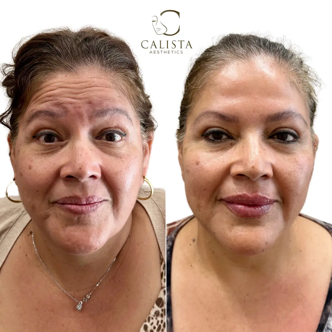 Before and after images showing the results of a facial balancing treatment from multiple angles.
