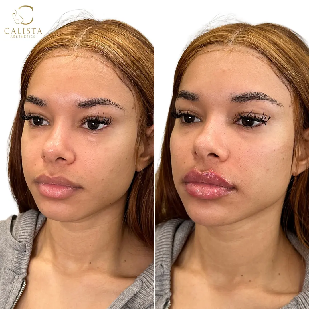 Before and after images showing facial balance following lip, cheek, and chin filler.