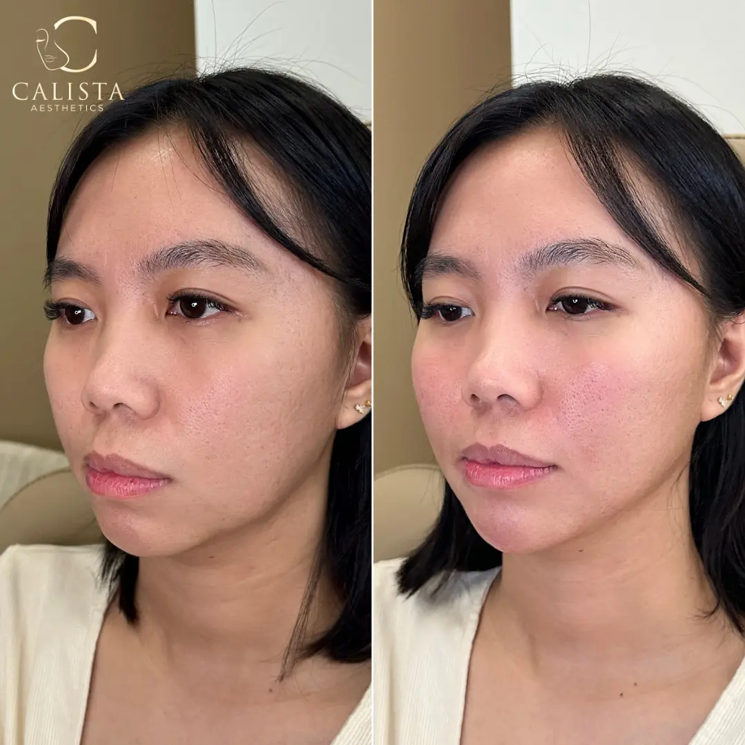 Before and after images showing the results of facial balancing with cheek and chin filler.