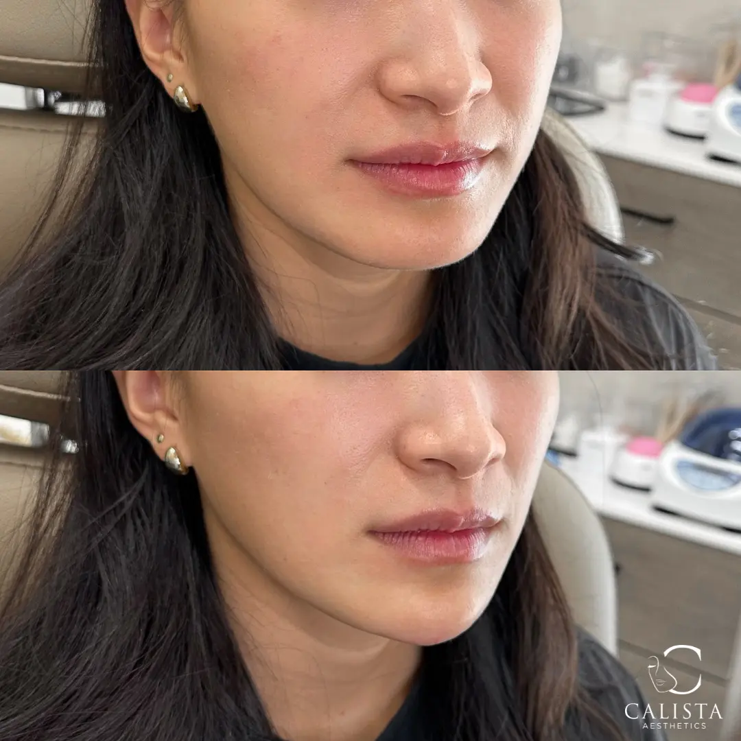 Before and after images showing facial balance following chin filler.