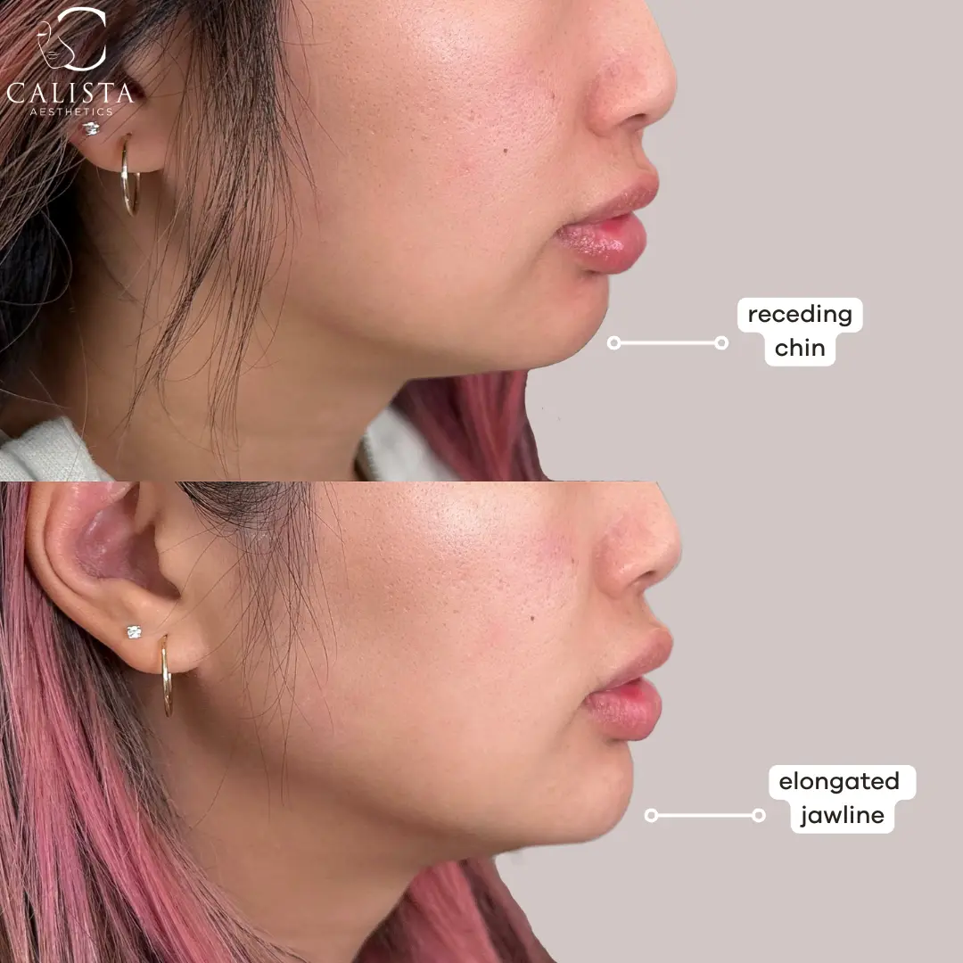 Before and after comparison showing the results of chin enhancement and improved facial contour.